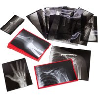Roylco Röntgenbilder eingerichteter Knochen
